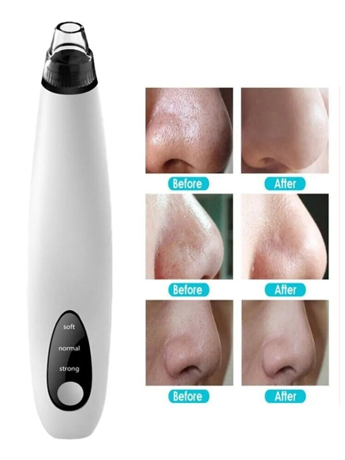 Diamond Pore Vacuum - Electric Blackhead Remover for Face